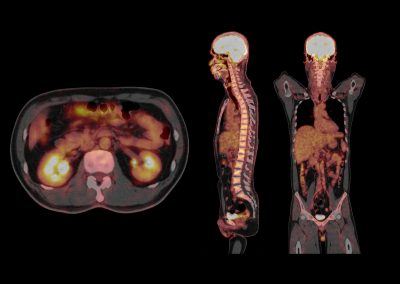 PET / CT