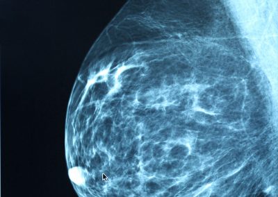 Mammography